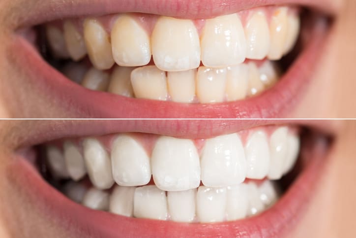 Natural Teeth Whitening